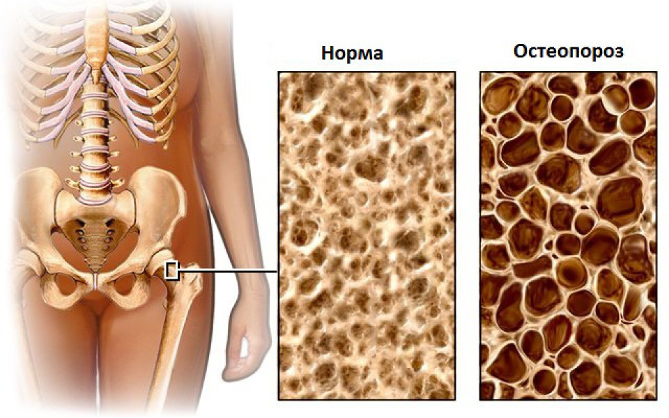 http://potomuchto.net/wp-content/uploads/2016/05/2.-Osobennosti-osteoporoza-960x600_c.jpg