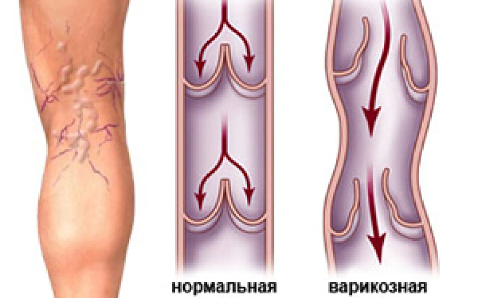 http://potomuchto.net/wp-content/uploads/2016/05/Pri-razvitii-varikoza-v-pervym-simptomam-dobavlyayutsya-uzhe-vidimye-priznaki-sosudistaya-setka-i-vypuklye-veny.-960x600_c.jpg